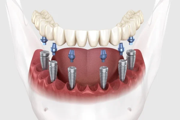 All on Six in Turkey: A Permanent Solution for Missing Teeth