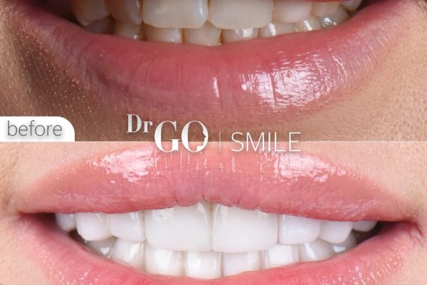 E-Max Laminate Veneers Before and After: Real Patient Stories