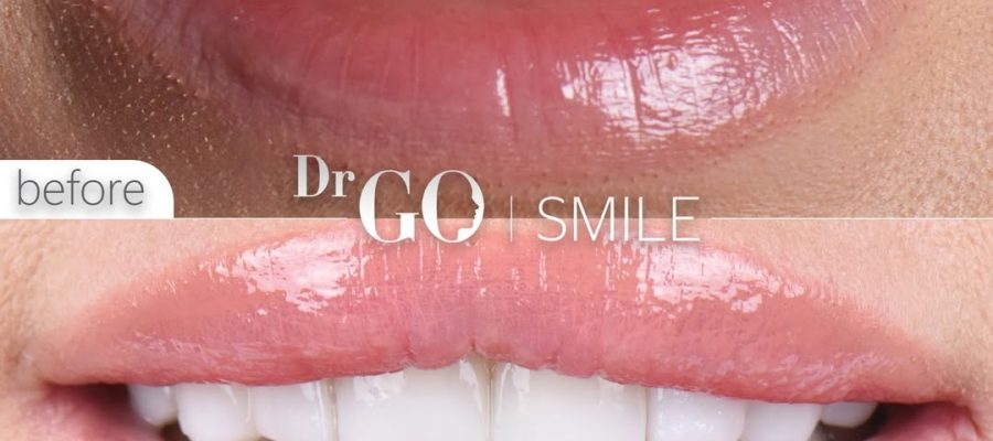 E-Max Laminate Veneers Before and After