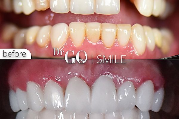 Dental Implants in Turkey: Why Choose Dr. GO Smile Clinic?