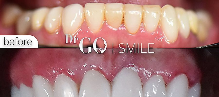 Dental Implants in Turkey