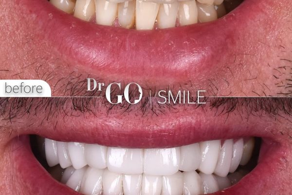 Dental Crowns in Turkey: A Guide to Quality, Affordability, and Aesthetics