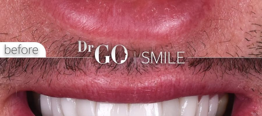 dental crowns in Turkey