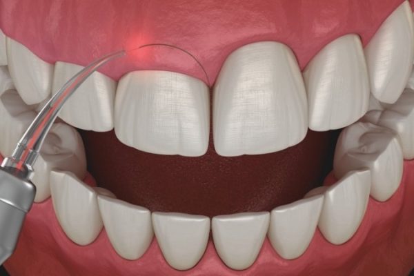 Gingivectomy in Turkey: A Comprehensive Guide