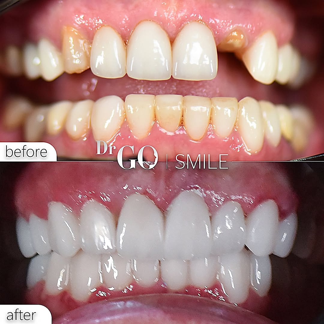dental implants in istanbul