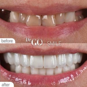 Zirconium Crowns in Turkey