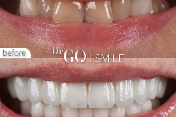 Zirconium Crowns in Turkey: The Perfect Blend of Aesthetics and Durability