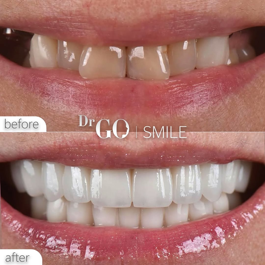 Zirconium Crowns