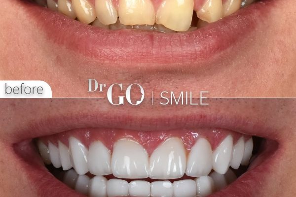 Dental Treatment in Turkey vs USA: A Comprehensive Comparison