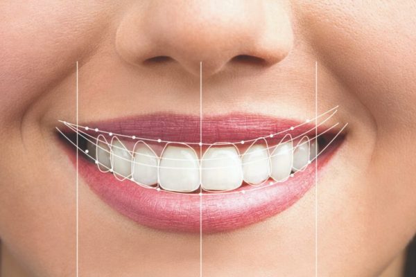 Perfect Smile Design in Istanbul: Your Gateway to a Radiant Smile