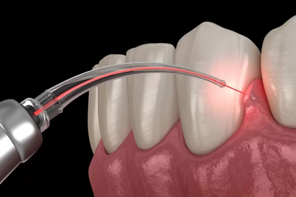 Laser Gum Treatment in Turkey: A Painless Solution for a Healthier Smile