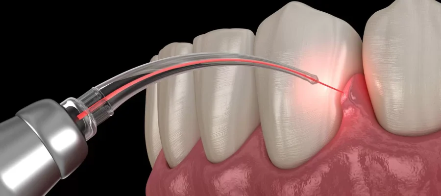laser gum treatment in istanbul