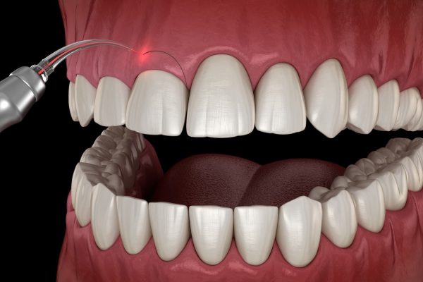 Gingivectomy in Istanbul: Enhance Your Smile with Expert Gum Contouring
