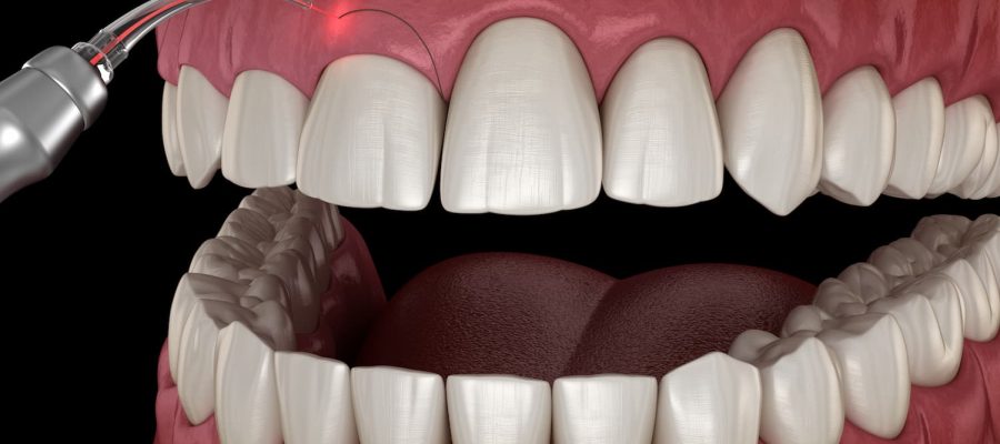 Gingivectomy in Istanbul