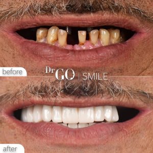 dental implant in istanbul