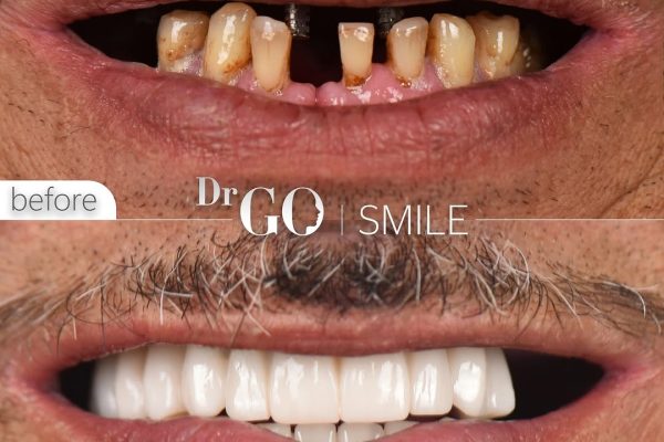 Why Getting a Dental Implant in Istanbul Is the Smart Choice for Your Smile