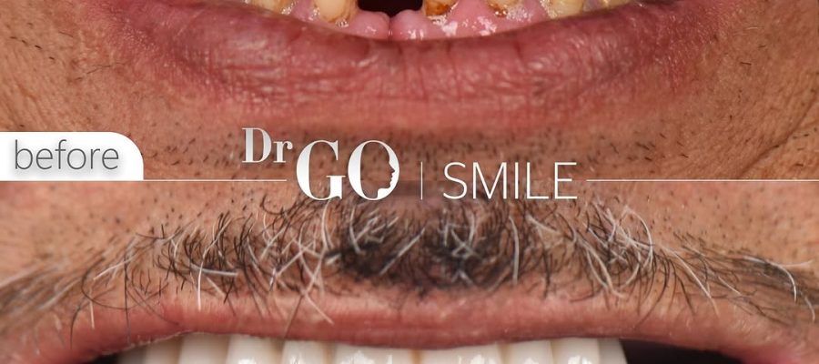 dental implant in istanbul