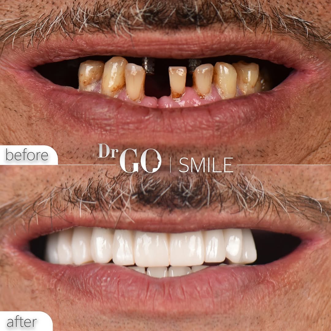 dental implant in istanbul
