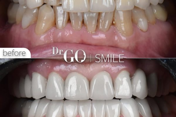 Dental Veneers Istanbul: The Best Way to Achieve a Beautiful Smile