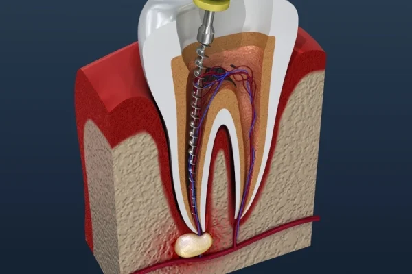Root Canal Treatments: A Pain-Free Solution to Save Your Natural Teeth