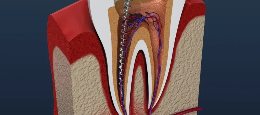 root canal treatment