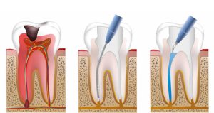 Root Canal Treatment Istanbul