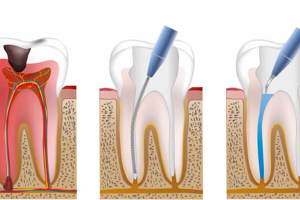 Root Canal Treatment Istanbul: A Comprehensive Guide to Pain-Free Dental Care