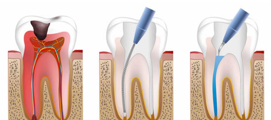Root Canal Treatment Istanbul