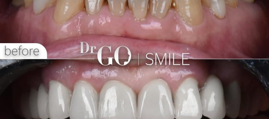 Porcelain Veneers Turkey