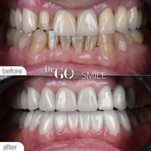 Dental Veneers in Turkey