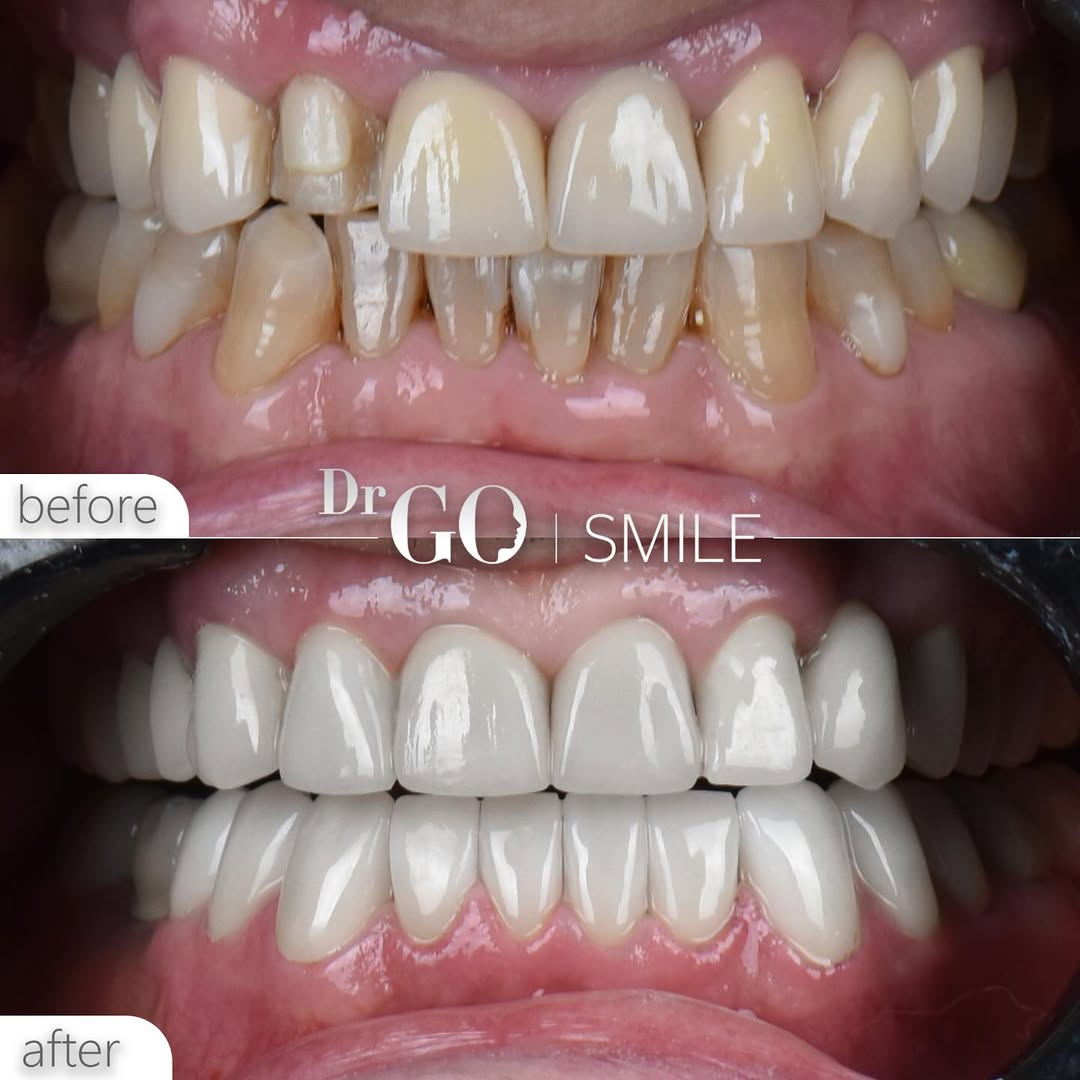 Dental Veneers in Turkey