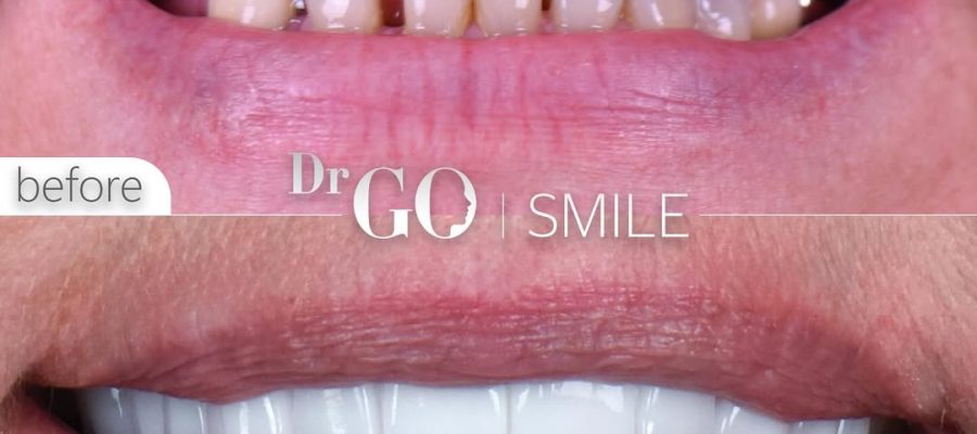 Zirconium Crowns Turkey