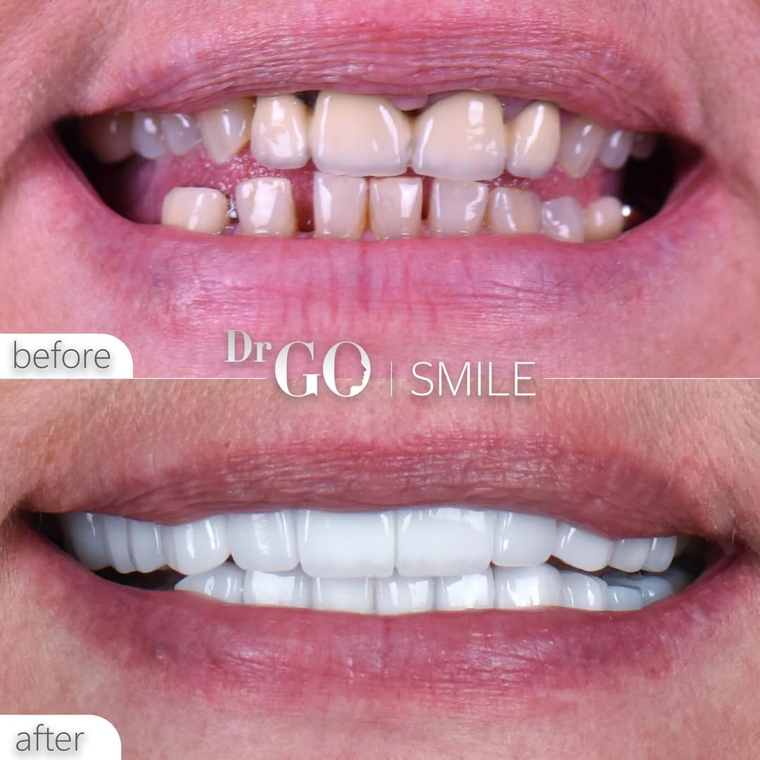 Zirconium Crowns Turkey