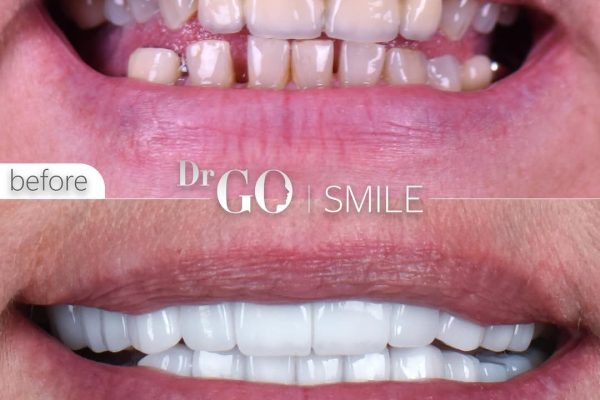 Hollywood Smile Istanbul: Transform Your Smile with Star-Quality Aesthetics