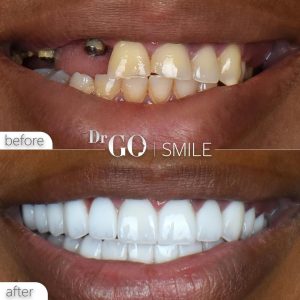 Dental Implant Costs in Turkey