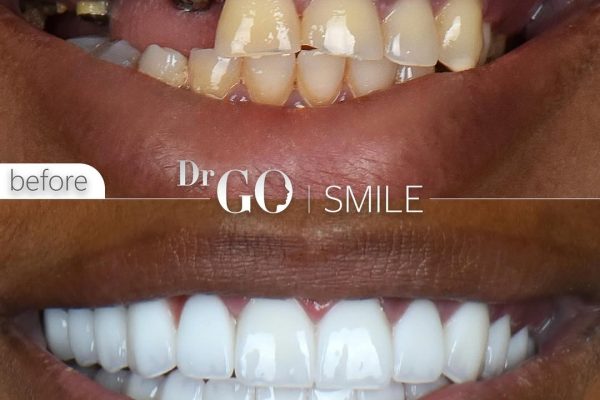 Dental Implant Costs in Turkey 2026: Affordable, High-Quality Solutions for a Beautiful Smile