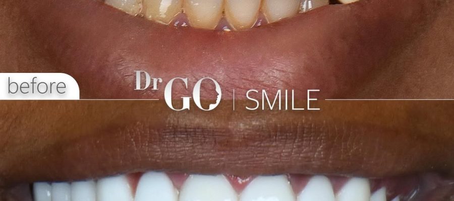 Dental Implant Costs in Turkey