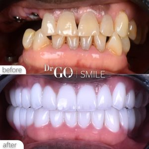 Dental Treatment Costs in Turkey for 2025
