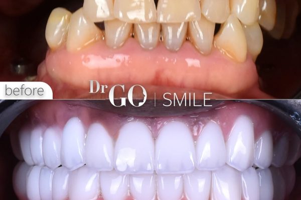 Dental Treatment Costs in Turkey for 2026: What to Expect