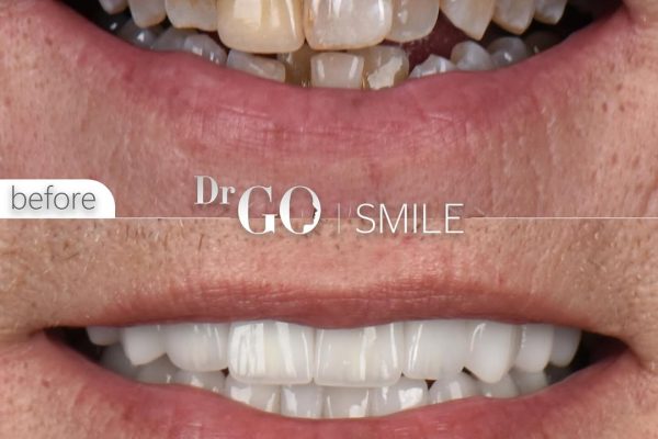 Why Istanbul Is the Best Place for a Hollywood Smile Transformation in 2026?
