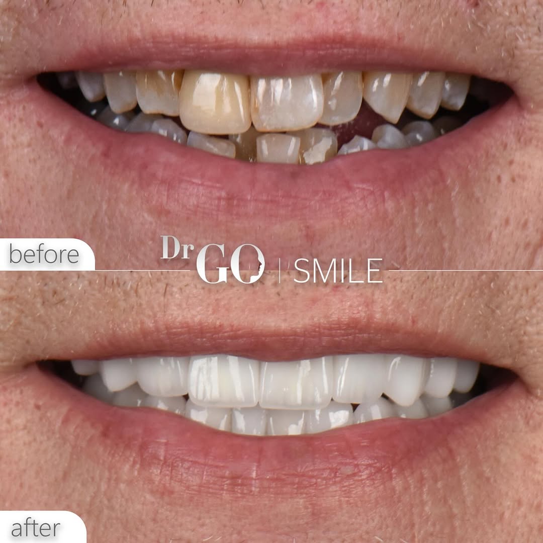 Hollywood Smile