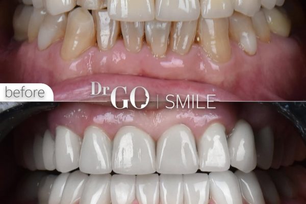 The Ultimate Guide to Getting Veneers in Istanbul: What You Need to Know Before Your Smile Makeover
