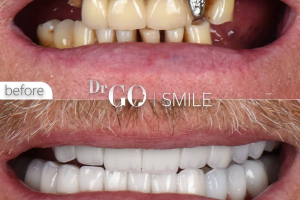 Dental Implants in Istanbul: A Long-Term Solution for Missing Teeth