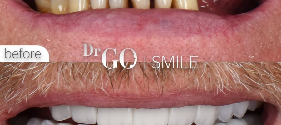 Dental Implants in Istanbul