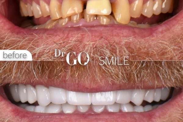 Hollywood Smile in Turkey: What to Expect and Why It’s So Popular