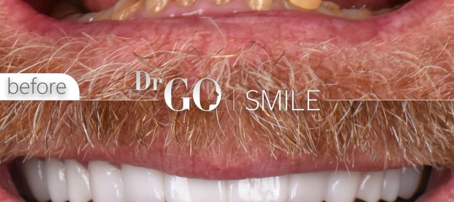 Hollywood Smile in Turkey