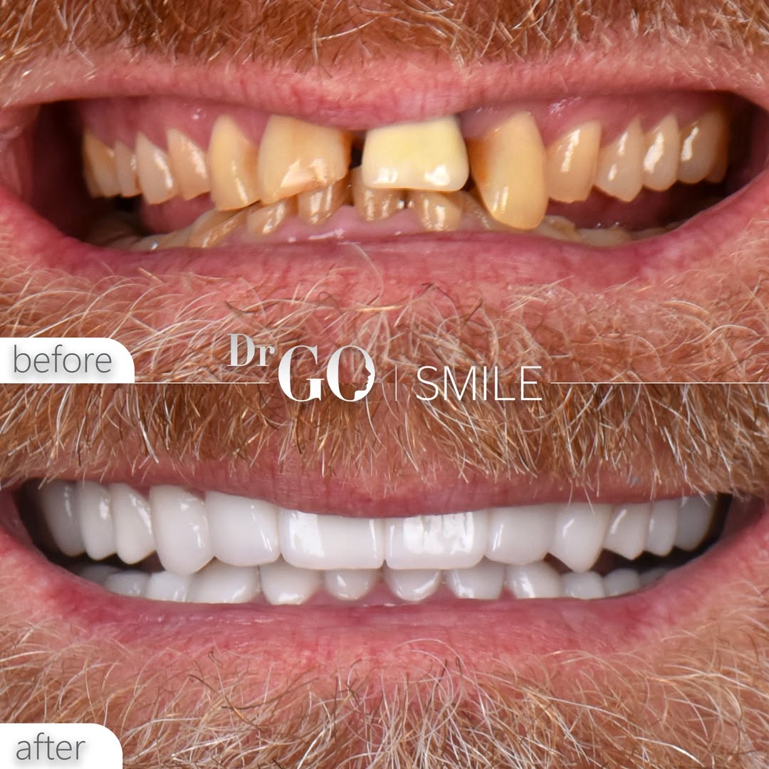 Hollywood Smile in Turkey