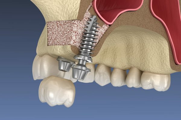 Sinus Lift Procedure: Essential Preparation for Successful Dental Implants