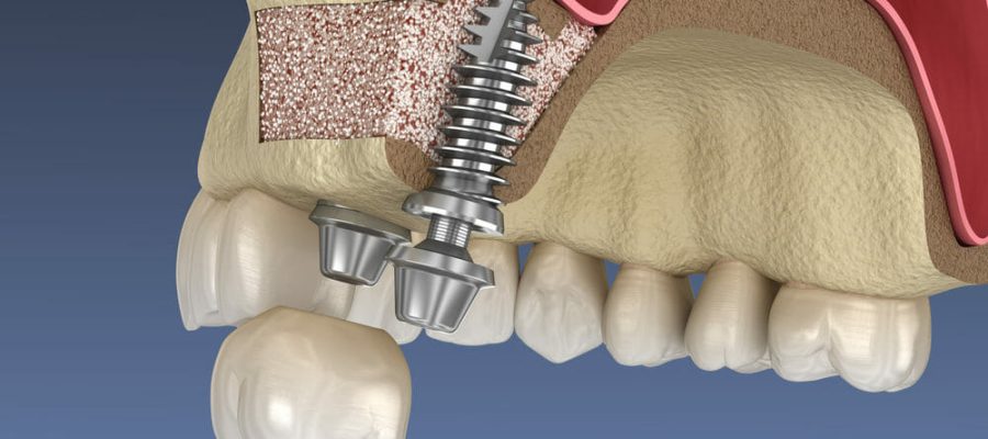 Sinus Lift Procedure