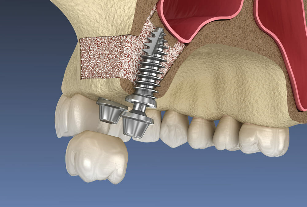 Sinus Lift Procedure